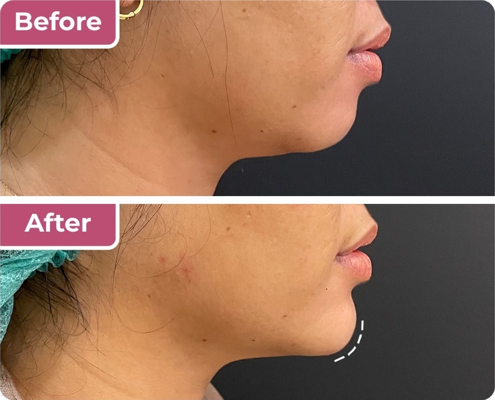 Sebelum dan sesudah filler dagu di Bella Derma Aesthetic