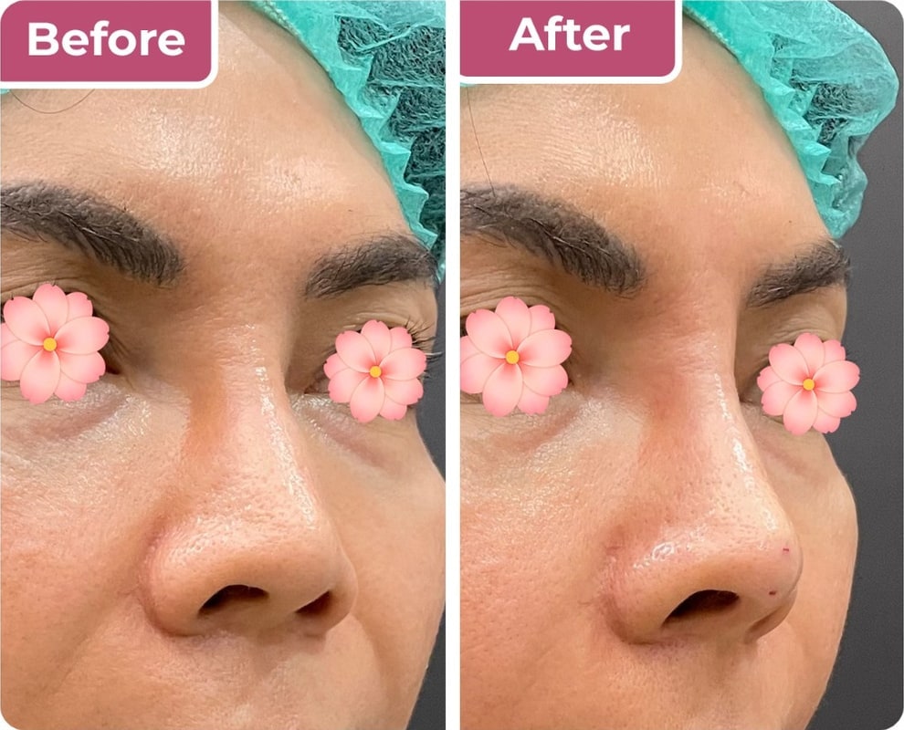 Sebelum dan sesudah nose threadlift di Bella Derma Aesthetic