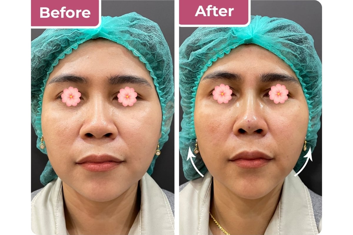 Tindakan threadlift wajah di Bella Derma Aesthetic