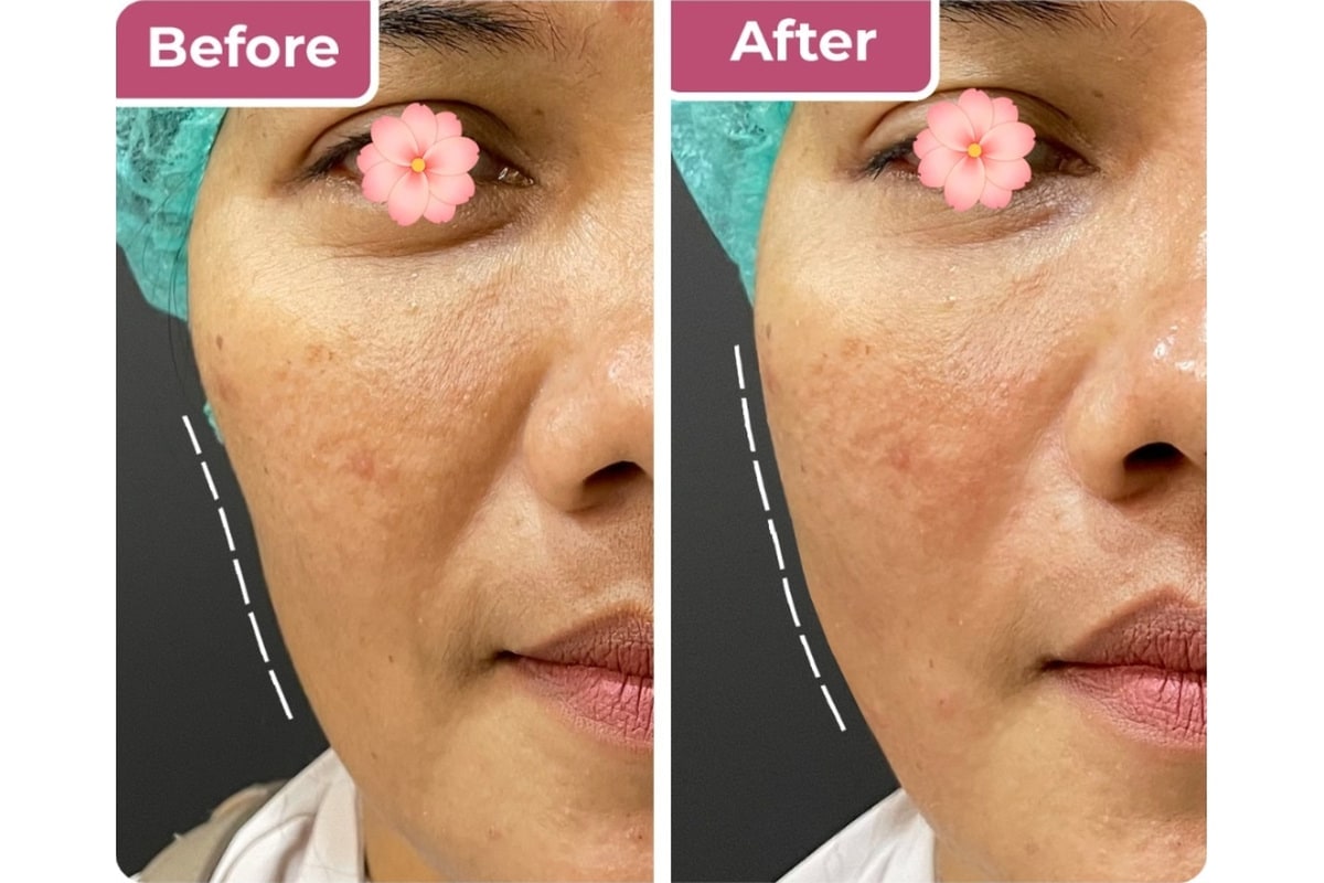 Tindakan filler wajah di Bella Derma Aesthetic