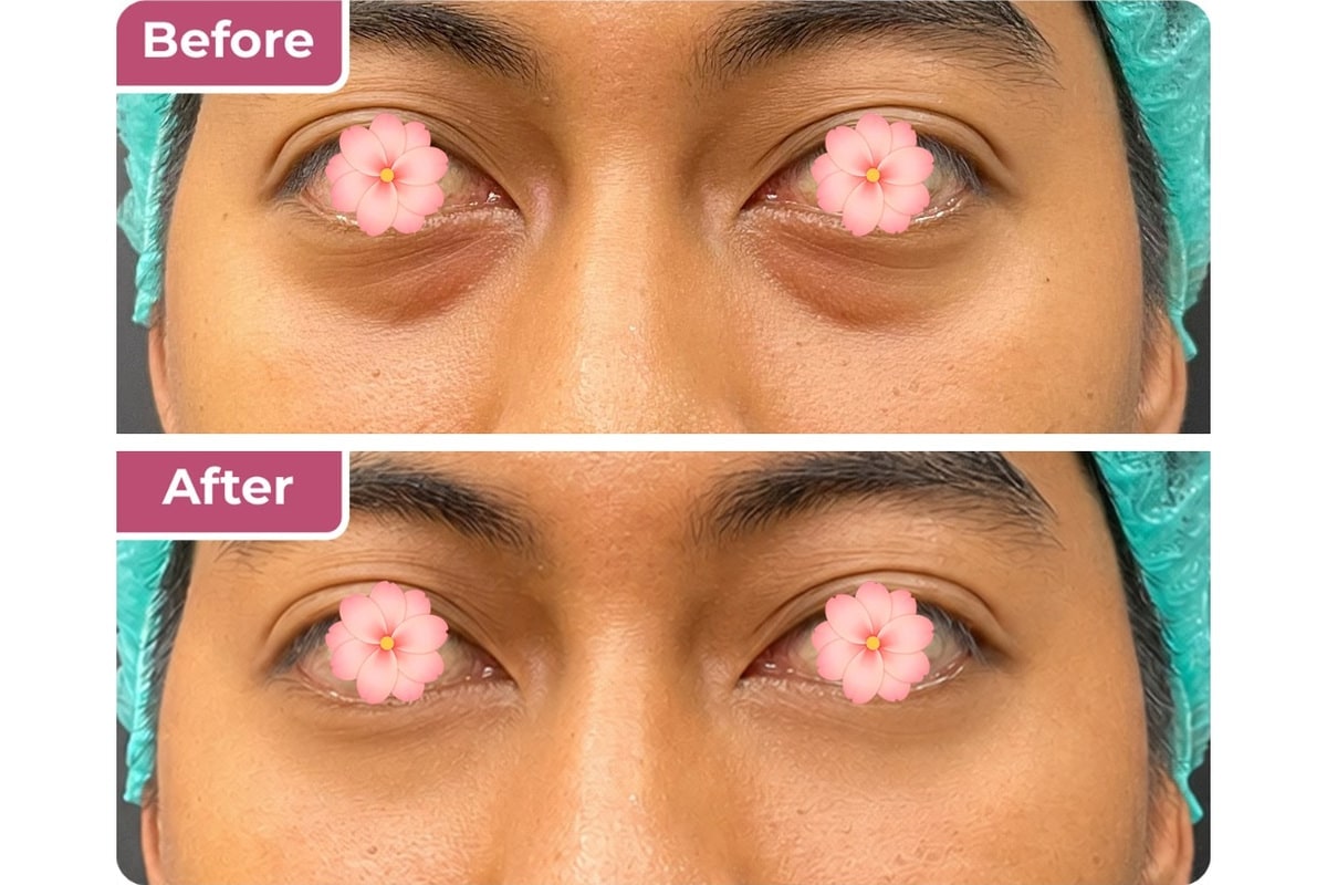Tindakan eyebag removal di Bella Derma Aesthetic